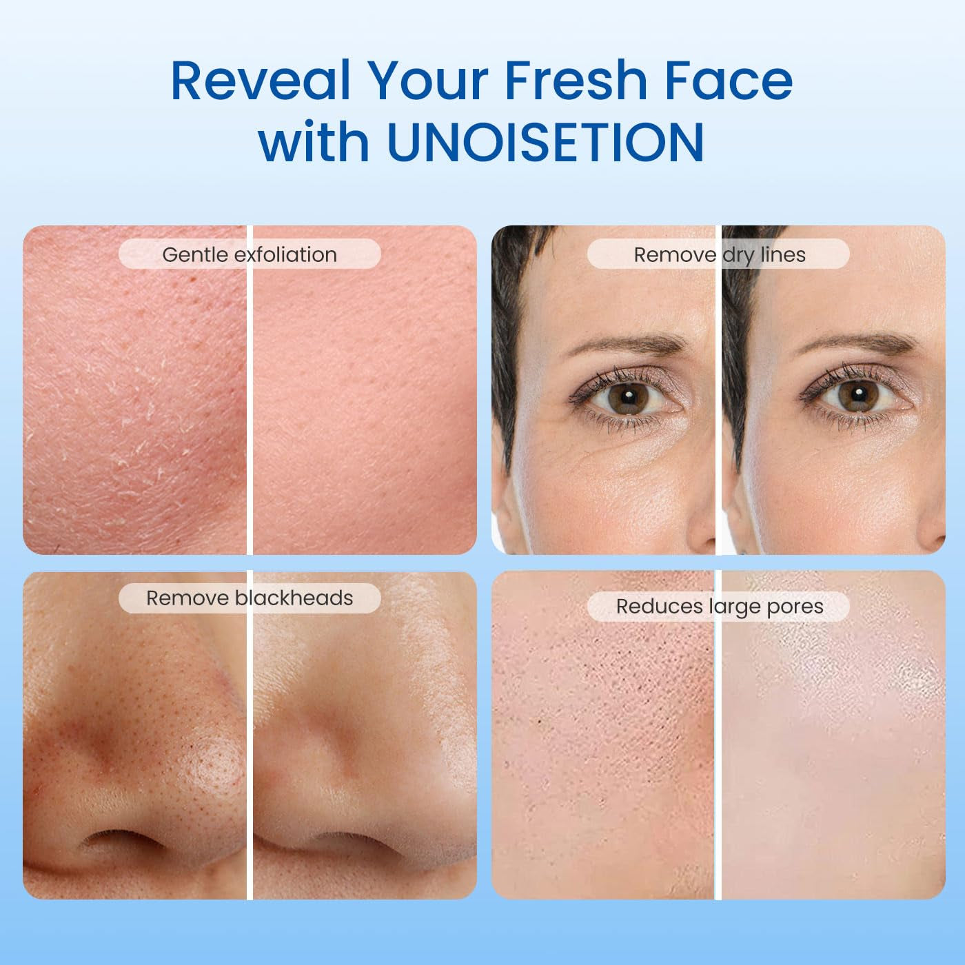 Diamond Microdermabrasion Machine, Dermabrasion Facial Machine for Exfoliation & Blackhead Removal, Home Use Facial Skin Care Equipment