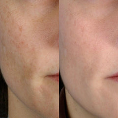 PMD Personal Microderm Classic - At-Home Microdermabrasion Machine with Kit for Face & Body