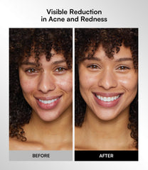 INIA Red Light LED Therapy for Face