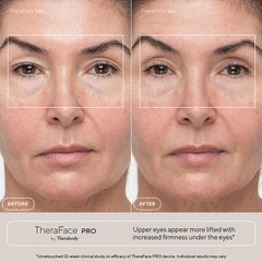 TheraFace PRO Microcurrent Facial Device - 8-in-1 Massager, LED Therapy & More