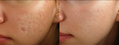 DermalPen Microneedling System