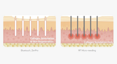 ZenPro Advanced CO2 Laser for Precision Skin Treatments