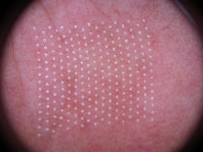 DEKA DOT Fractional CO2 Laser