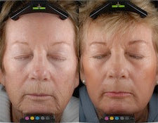 DEKA DOT Fractional CO2 Laser