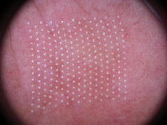DEKA DOT Fractional CO2 Laser
