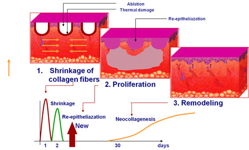DEKA DOT Fractional CO2 Laser