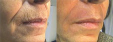 DEKA DOT Fractional CO2 Laser