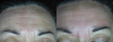 DEKA DOT Fractional CO2 Laser