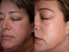DEKA DOT Fractional CO2 Laser