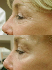 DEKA DOT Fractional CO2 Laser