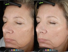 DEKA DOT Fractional CO2 Laser