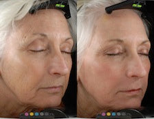 DEKA DOT Fractional CO2 Laser